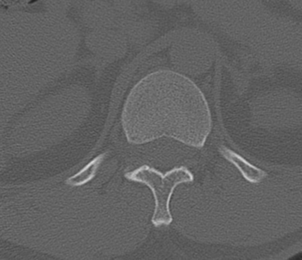 File:Acute L1 burst compression fracture (Radiopaedia 34430-35755 Axial bone window 3).png