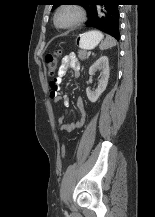 Acute appendicitis (Radiopaedia 48511-53463 Sagittal C+ portal venous phase 95).jpg