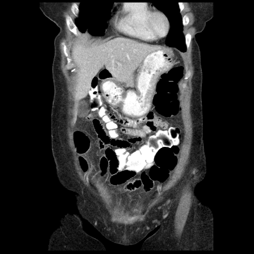 Acute appendicitis (Radiopaedia 52672-58589 Coronal C+ portal venous phase 9).jpg