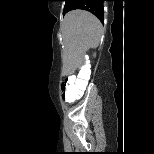 File:Acute appendicitis (Radiopaedia 52672-58589 Sagittal C+ arterial phase 17).jpg