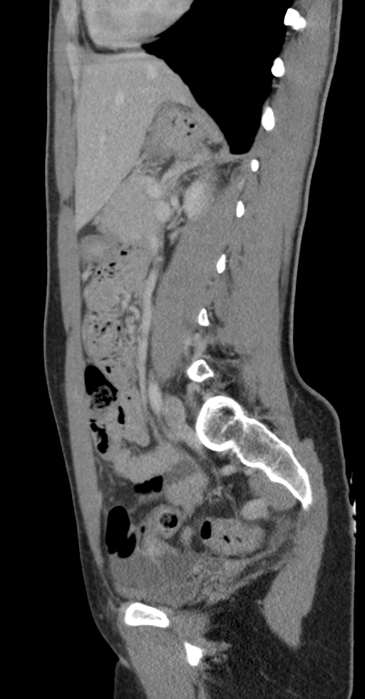 Acute appendicitis (Radiopaedia 62608-70901 Sagittal C+ portal venous phase 7).jpg
