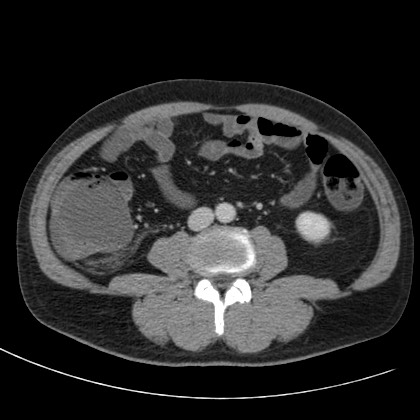 File:Acute appendicitis (Radiopaedia 66513-75790 Axial C+ portal venous phase 46).jpg