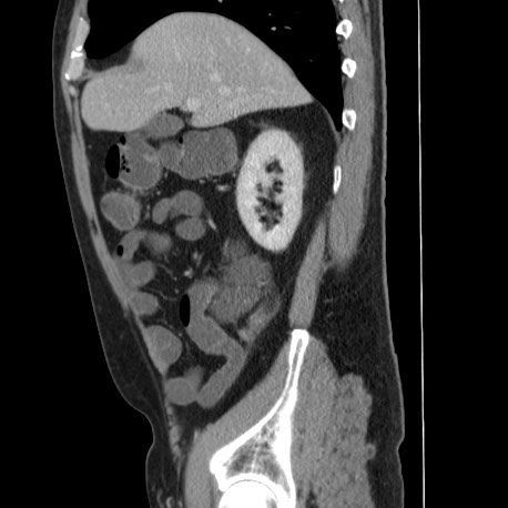 Acute appendicitis (Radiopaedia 66513-75790 Sagittal C+ portal venous phase 42).jpg