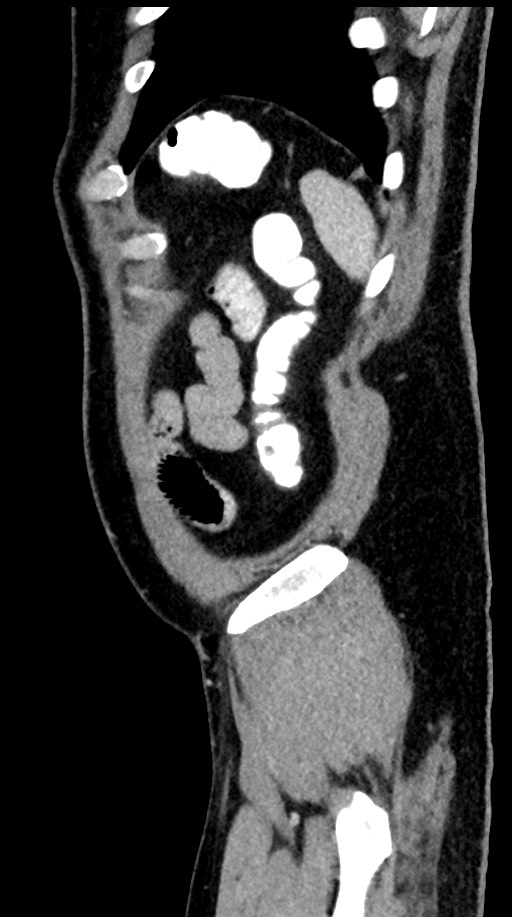 Acute appendicitis (Radiopaedia 77016-88960 Sagittal C+ portal venous phase 14).jpg