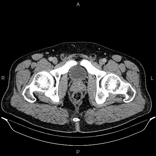 File:Acute appendicitis (Radiopaedia 84780-100240 Axial C+ portal venous phase 109).jpg