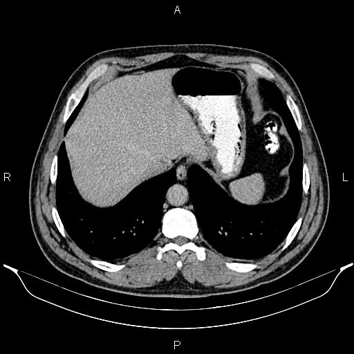 File:Acute appendicitis (Radiopaedia 84780-100240 Axial C+ portal venous phase 15).jpg