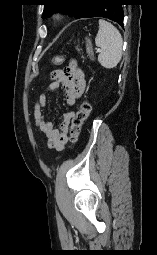 Acute appendicitis - large appendicoliths (Radiopaedia 61805-69820 Sagittal C+ portal venous phase 23).jpg