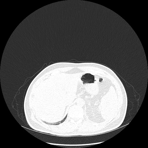 File:Acute appendicitis and COVID 19 pneumonia (Radiopaedia 76604-88380 Axial lung window 54).jpg