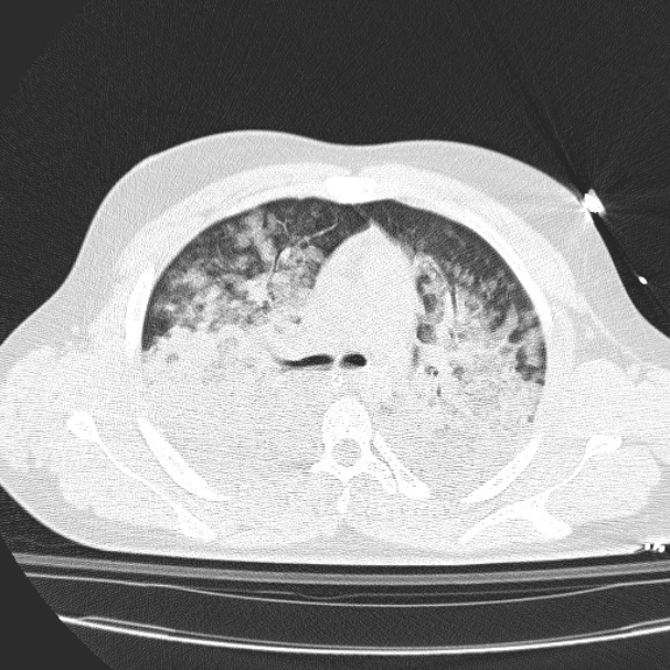 Acute aspiration pneumonitis (Radiopaedia 33605-34703 Axial lung window 39).jpg