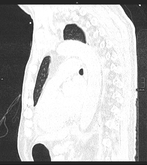Acute aspiration pneumonitis (Radiopaedia 55642-62166 Sagittal lung window 61).jpg