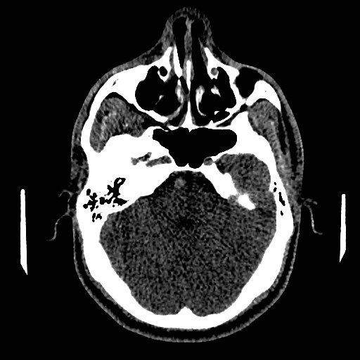 Acute basilar artery occlusion (Radiopaedia 43582-46985 Axial non-contrast 61).jpg