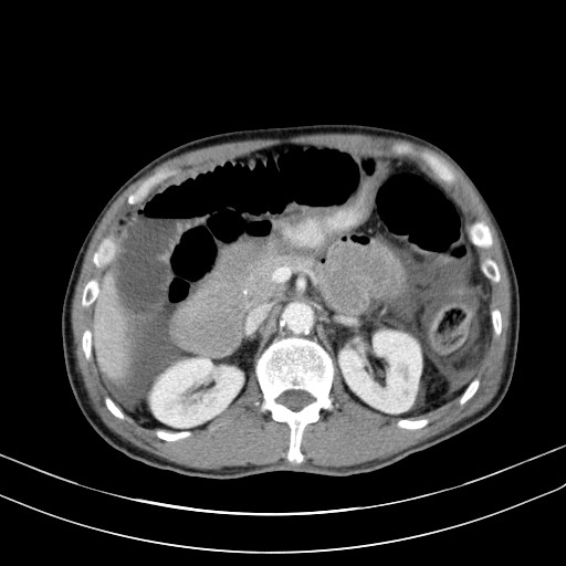 Acute bowel ischemia (Radiopaedia 87695-104114 Axial C+ portal venous phase 30).jpg