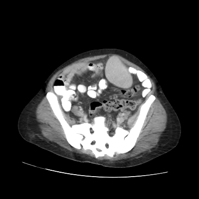 Acute calculous cholecystitis in patient with osteopetrosis (Radiopaedia 77871-90159 Axial C+ portal venous phase 62).jpg