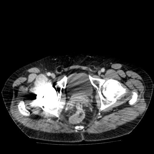 File:Acute cholecystitis and incidental left sided IVC (Radiopaedia 49352-54459 Axial C+ portal venous phase 150).jpg