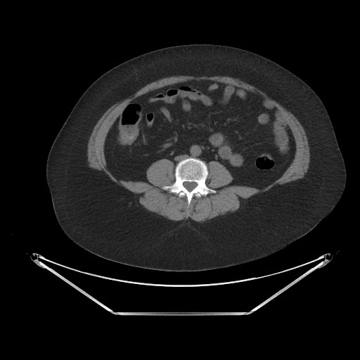 Acute cholecystitis with tensile fundus sign (Radiopaedia 71394-81723 Axial non-contrast 62).jpg