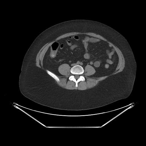 Acute cholecystitis with tensile fundus sign (Radiopaedia 71394-81723 Axial non-contrast 68).jpg