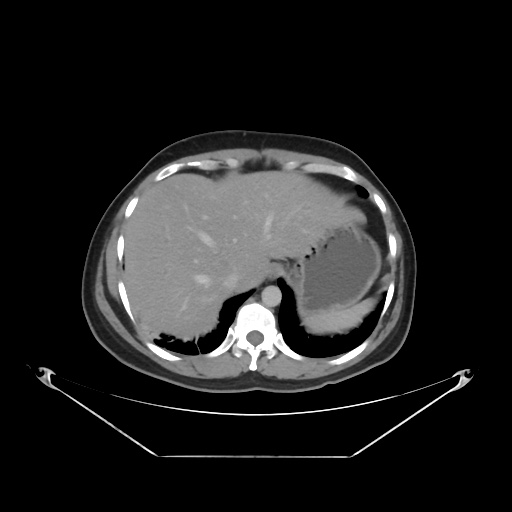 File:Acute complicated calculous cholecystitis (Radiopaedia 55202-61587 Axial C+ delayed 23).jpg