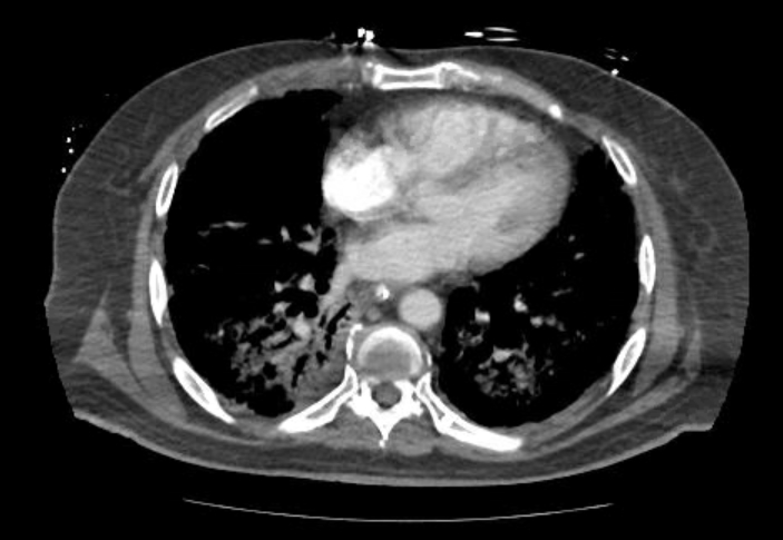 Acute cor pulmonale (ultrasound) (Radiopaedia 83508-98818 Axial C+ CTPA 48).jpg