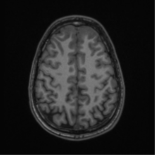 Acute disseminated encephalomyelitis (ADEM) (Radiopaedia 65319-74349 Axial T1 51).png