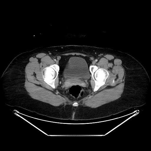 Acute diverticulitis - transverse colon (Radiopaedia 87063-103327 Axial C+ portal venous phase 157).jpg