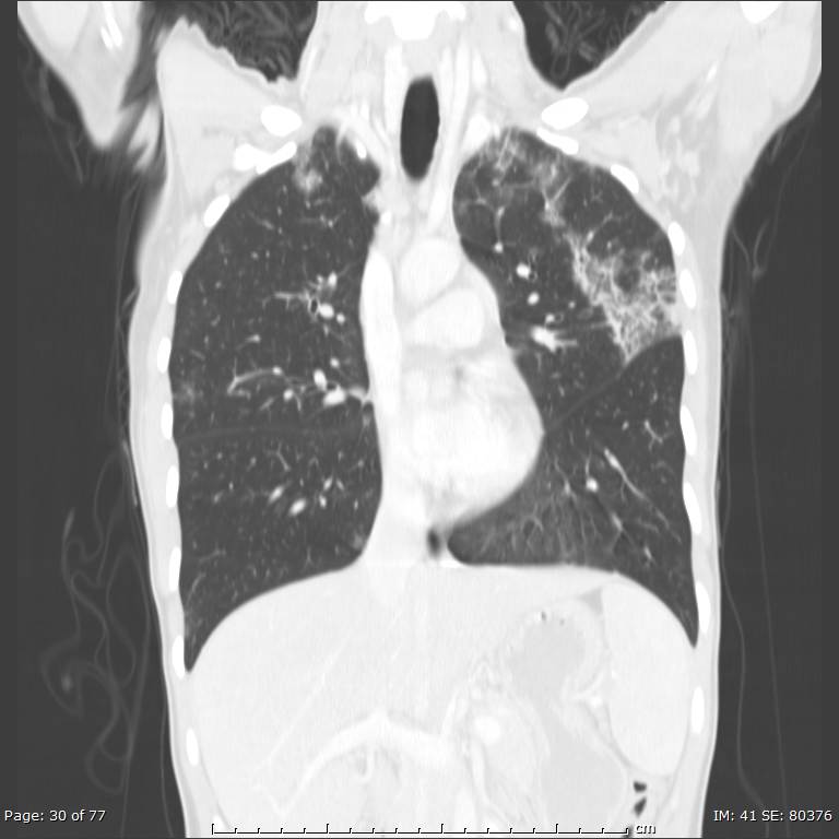 Acute eosinophilic pneumonia (Radiopaedia 48211-53073 Coronal lung window 19).jpg
