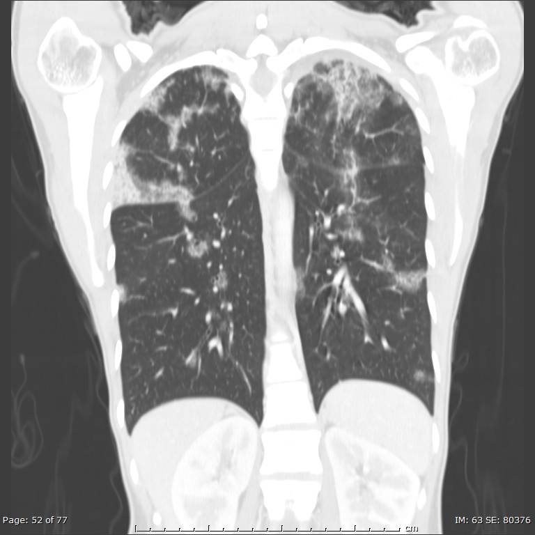 Acute eosinophilic pneumonia (Radiopaedia 48211-53073 Coronal lung window 35).jpg