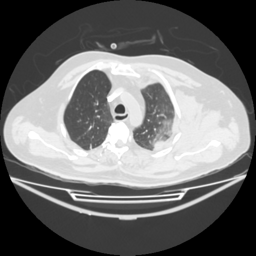 File:Acute heart failure (CT) (Radiopaedia 79835-93075 Axial lung window 12).png