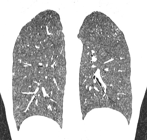 File:Acute hypersensitivity pneumonitis (Radiopaedia 85293-100870 Coronal lung window 95).jpg