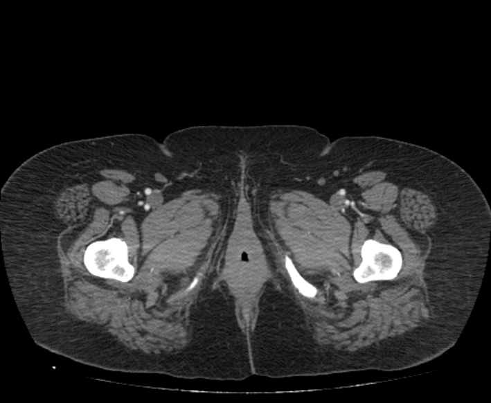 Acute mesenteric ischemia (Radiopaedia 80029-93316 Axial C+ arterial phase 147).jpg