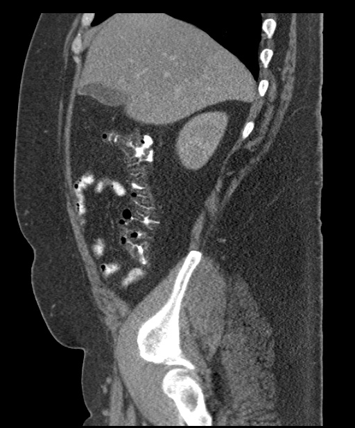 Acute mesenteric venous ischemia (Radiopaedia 46041-50383 Sagittal C+ portal venous phase 26).jpg