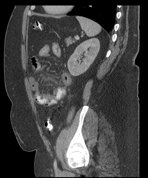 Acute mesenteric venous ischemia (Radiopaedia 46041-50383 Sagittal C+ portal venous phase 85).jpg