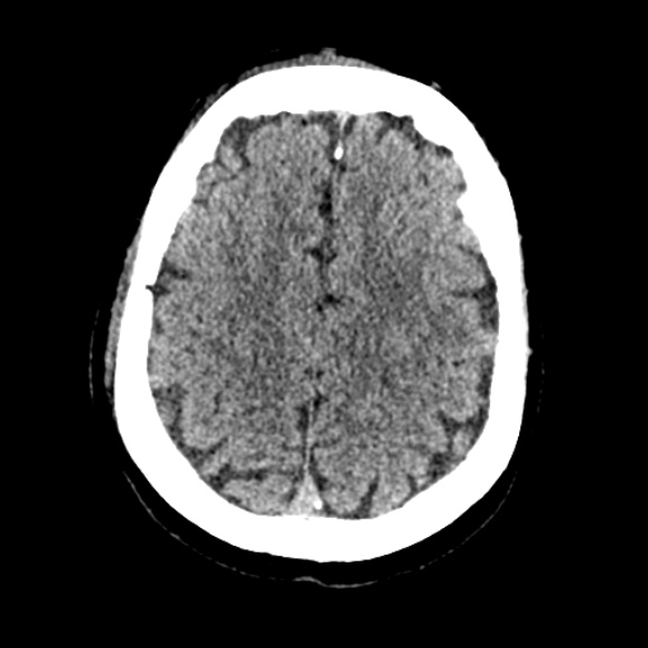 Acute middle cerebral artery territory infarct (Radiopaedia 52380-58283 Axial non-contrast 82).jpg
