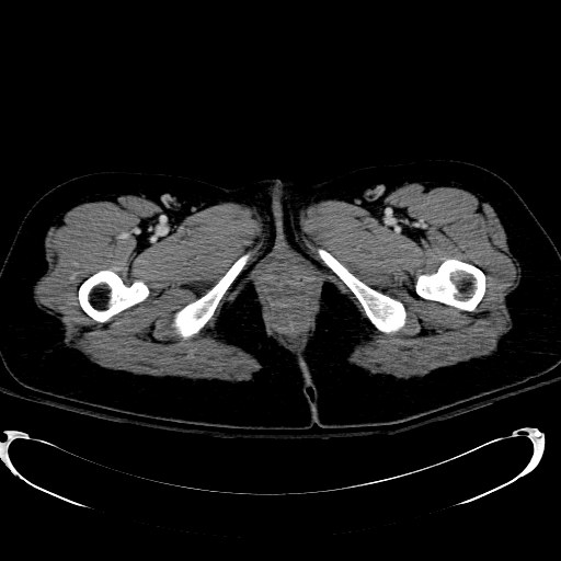 Acute myocardial infarction in CT (Radiopaedia 39947-42415 Axial C+ portal venous phase 149).jpg