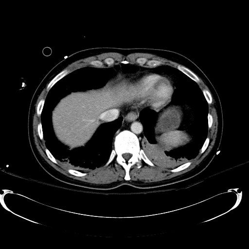 File:Acute myocardial infarction in CT (Radiopaedia 39947-42415 Axial C+ portal venous phase 16).jpg