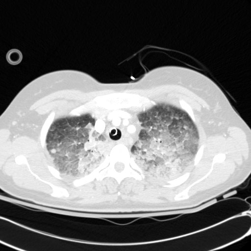 Acute myocardial infarction in CT (Radiopaedia 39947-42415 Axial lung window 26).jpg