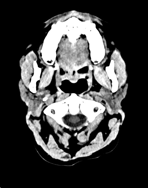 Acute on chronic subdural hematoma (Radiopaedia 74814-85823 Axial non-contrast 20).jpg