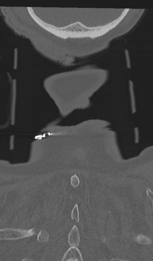 Acute on chronic subdural hematoma and thoracic vertebral injury in a multitrauma patient (Radiopaedia 31698-32619 Coronal bone window 71).jpg