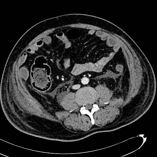 File:Acute pancreatic necrosis (Radiopaedia 13560-13486 Axial C+ portal venous phase 96).jpg