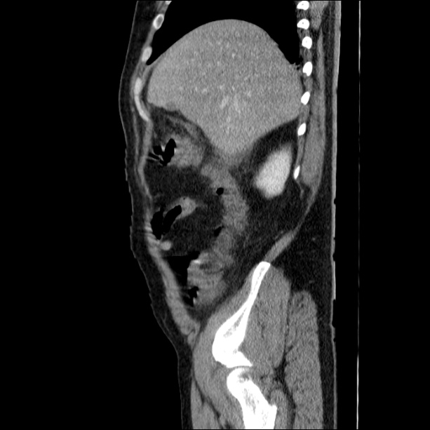 Acute pancreatitis (Radiopaedia 26663-26813 Sagittal C+ portal venous phase 16).jpg