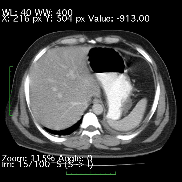 Acute pancreatitis (Radiopaedia 34043-35276 Axial C+ portal venous phase 15).jpg