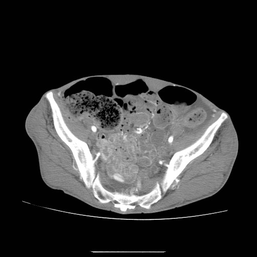 File:Acute pancreatitis (Radiopaedia 50213-55558 Axial C+ arterial phase 44).jpg