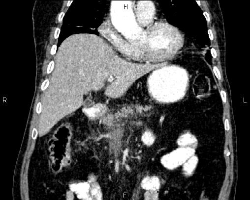 Acute pancreatitis (Radiopaedia 85146-100701 Coronal C+ portal venous phase 27).jpg