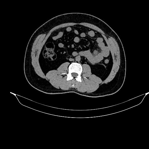 File:Acute pancreatitis (Radiopaedia 87428-103757 Axial non-contrast 53).jpg
