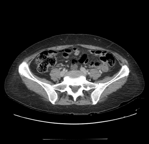 File:Acute pancreatitis - Balthazar E - post ERCP (Radiopaedia 27562-27772 Axial C+ portal venous phase 53).png