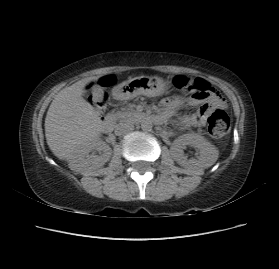 File:Acute pancreatitis - Balthazar E - post ERCP (Radiopaedia 27562-27772 Axial non-contrast 24).png