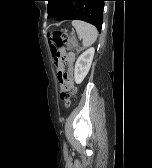 Acute pancreatitis - Balthazar E - post ERCP (Radiopaedia 27562-27772 Sagittal C+ portal venous phase 109).png