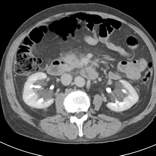 Acute pancreatitis and walled-off necrosis (Radiopaedia 29888-30403 Axial C+ delayed 39).jpg