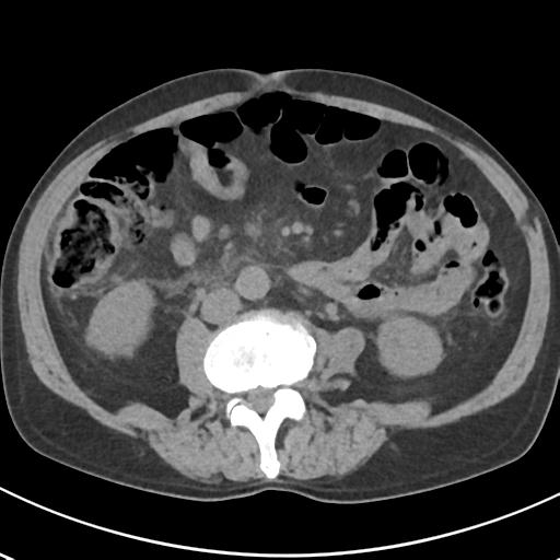 File:Acute pancreatitis and walled-off necrosis (Radiopaedia 29888-30404 Axial non-contrast 43).jpg