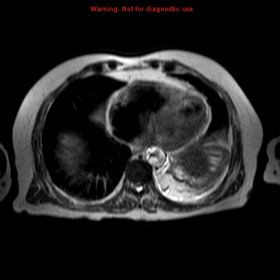 File:Acute pancreatitis with incidental pancreatic lipoma (Radiopaedia 10190-10732 Axial T2 27).jpg