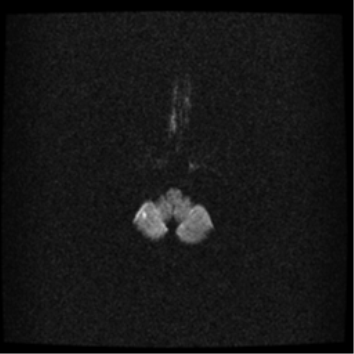 File:Acute pontine infarct from vertebral artery dissection (Radiopaedia 34111-35370 Axial DWI 3).png